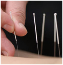 acupunctuur